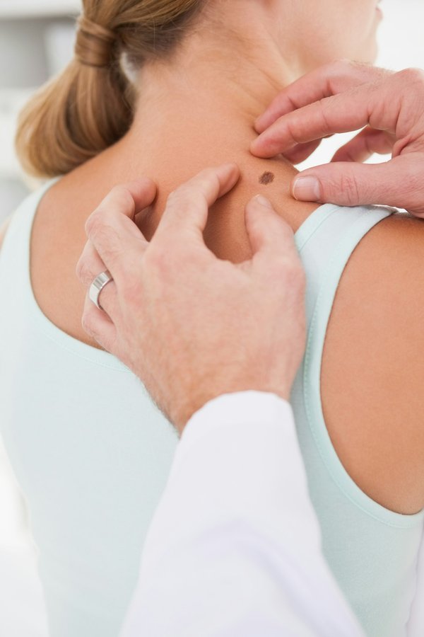 Tache brune sur la peau : astuces pour un teint radieux